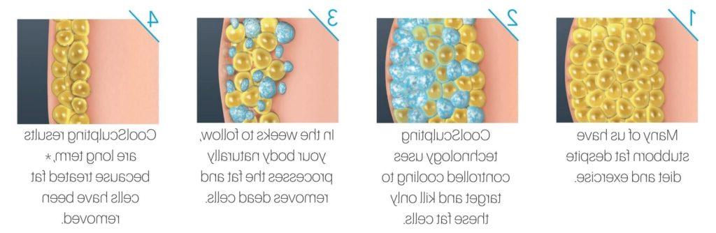 Inforgraphic of how CoolSculpting works